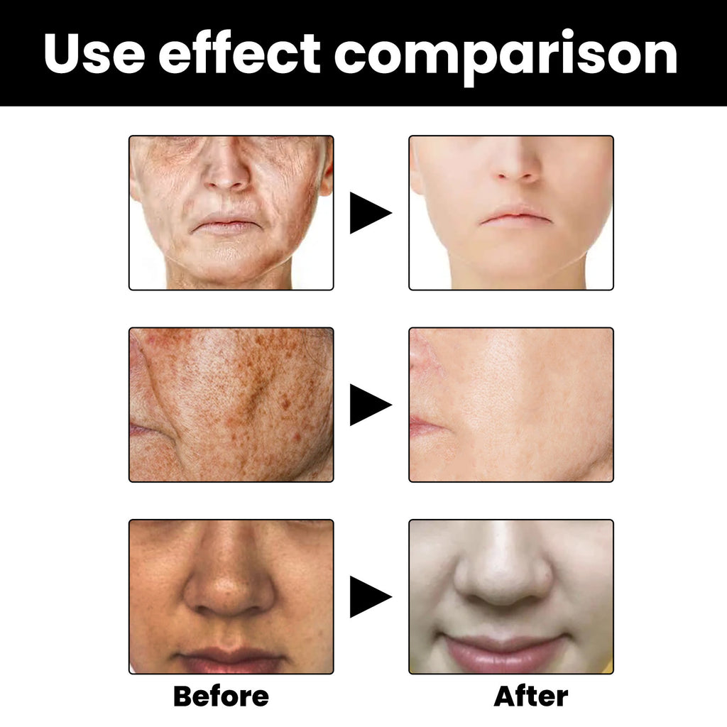 Before and after effect comparison of skin treatment on a person's face.